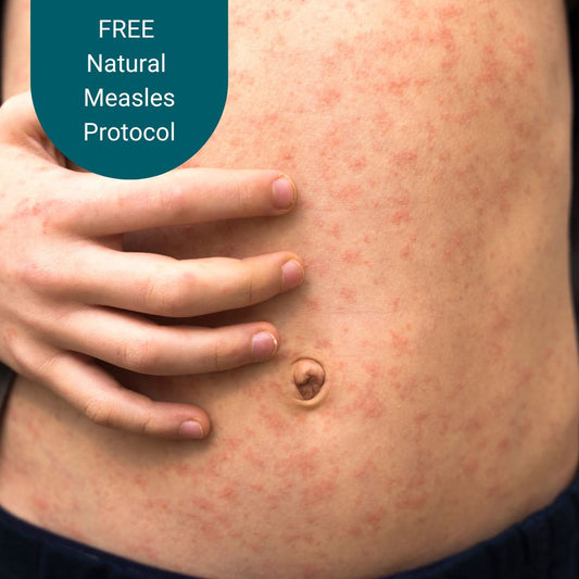 Natural Measles Protocol